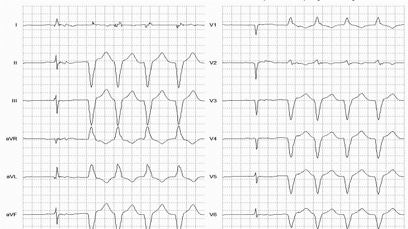 Idioventricular Rhythm 12 Lead EKG